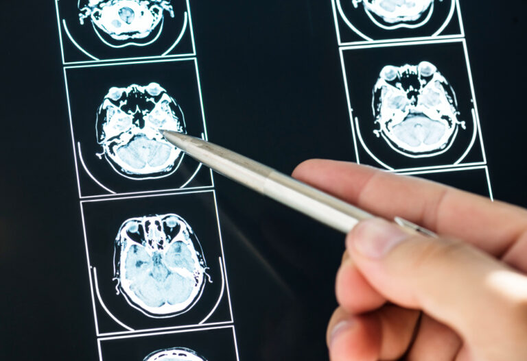 5 Ways to Get Compensation for Cognitive Issues After a Brain Injury